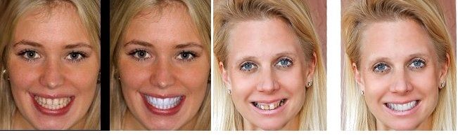 Smile Simulation in Buford, GA - Radiant Dental