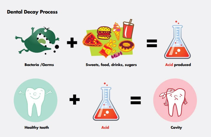 Dental Decay Process Illustration
